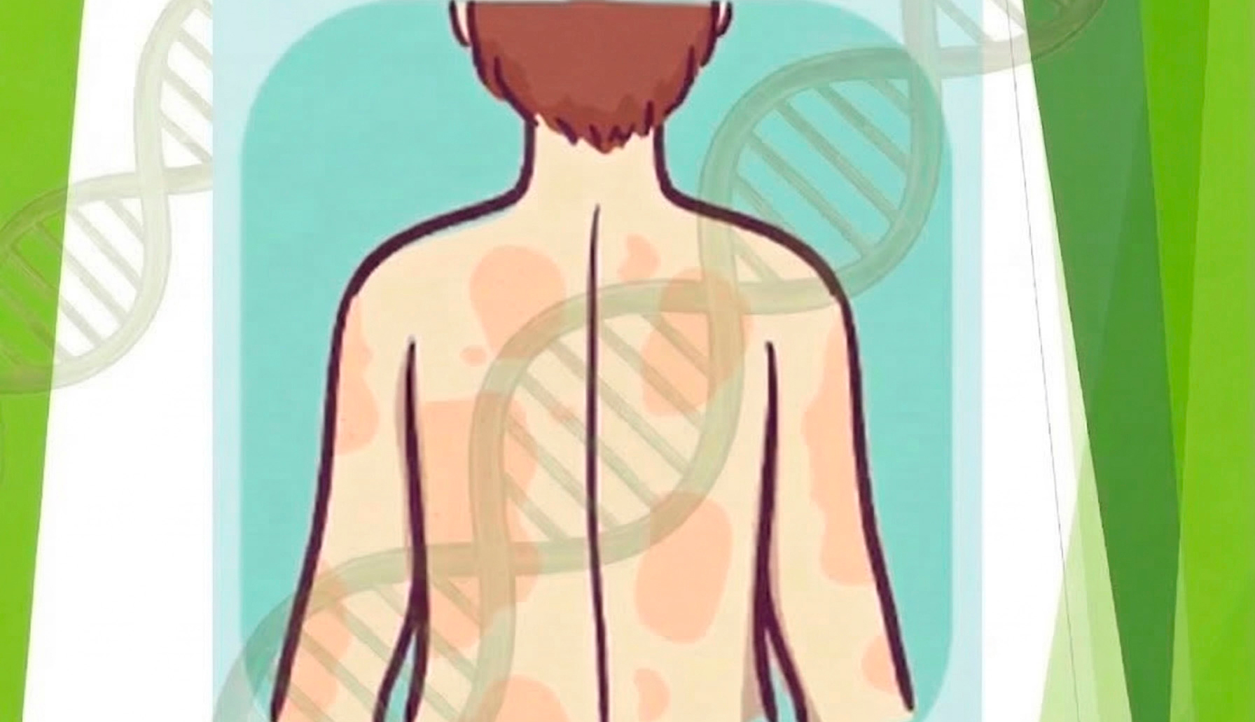 Neurofibromatosis Tipo I. Una aproximación diagnóstica ¿Cómo es vivir con una enfermedad genética? 25 de marzo. 15:30